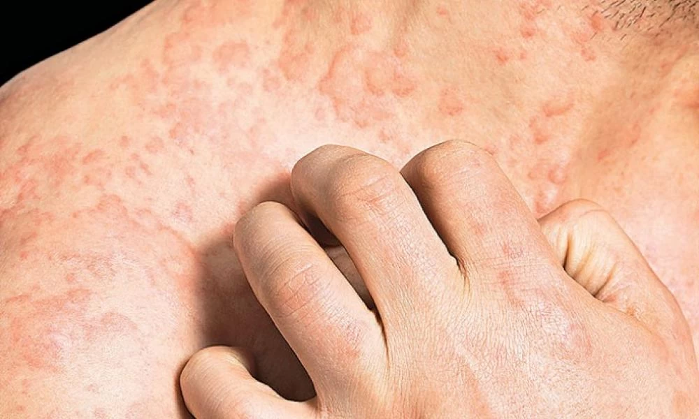 Τα πρώτα 30 λεπτά: Αναφυλαξία μετά το εμβόλιο COVID-19